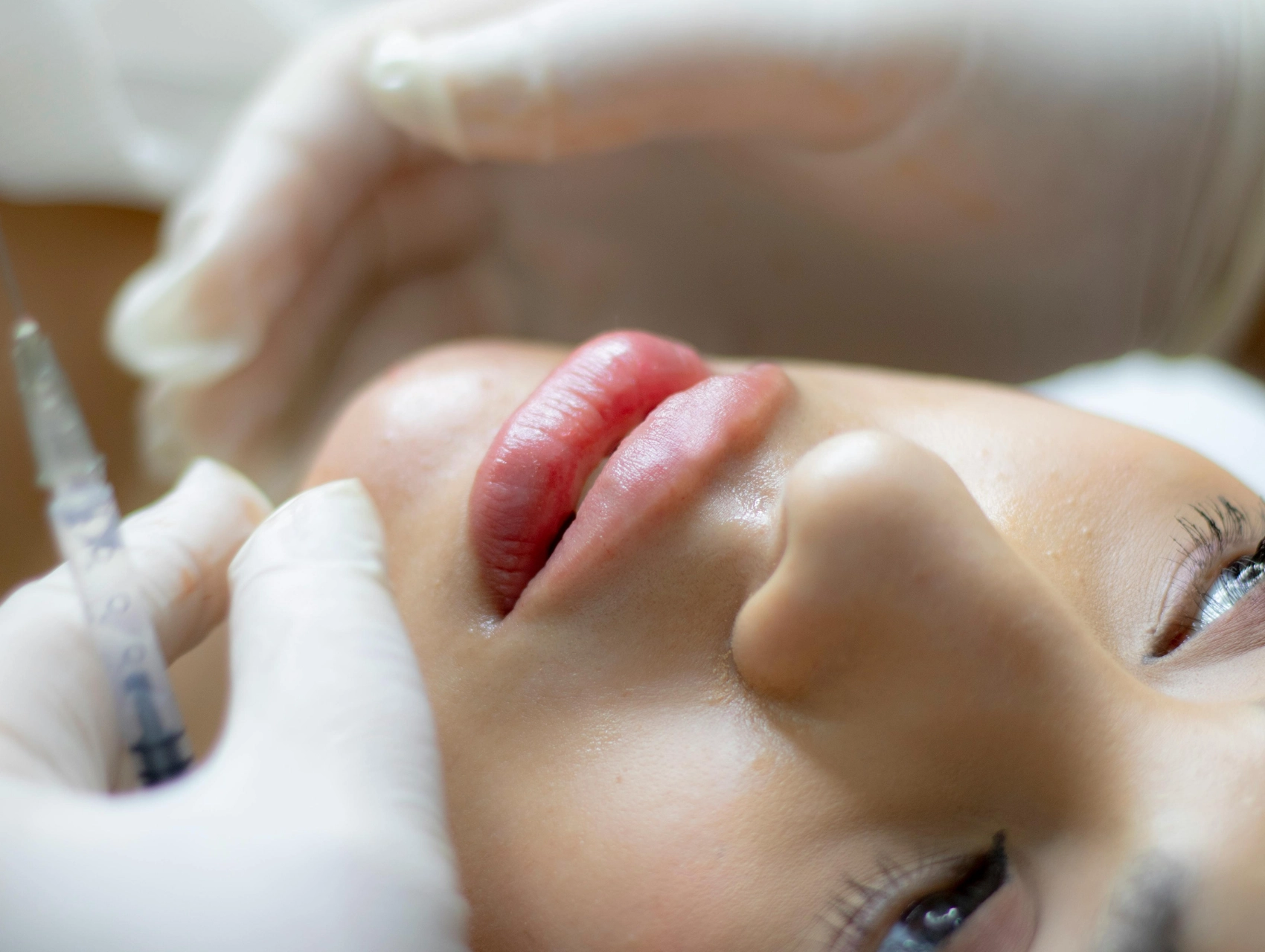 Close-up of a woman receiving a cosmetic lip filler injection by a gloved professional.