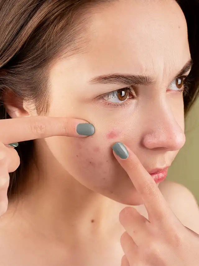 acne hormonal