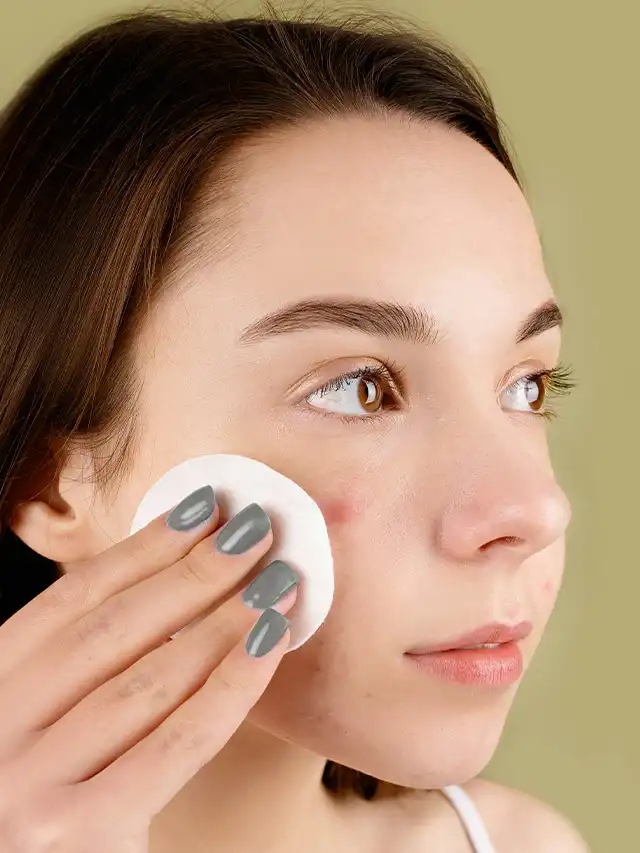 acne hormonal