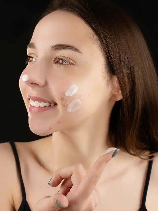acne hormonal