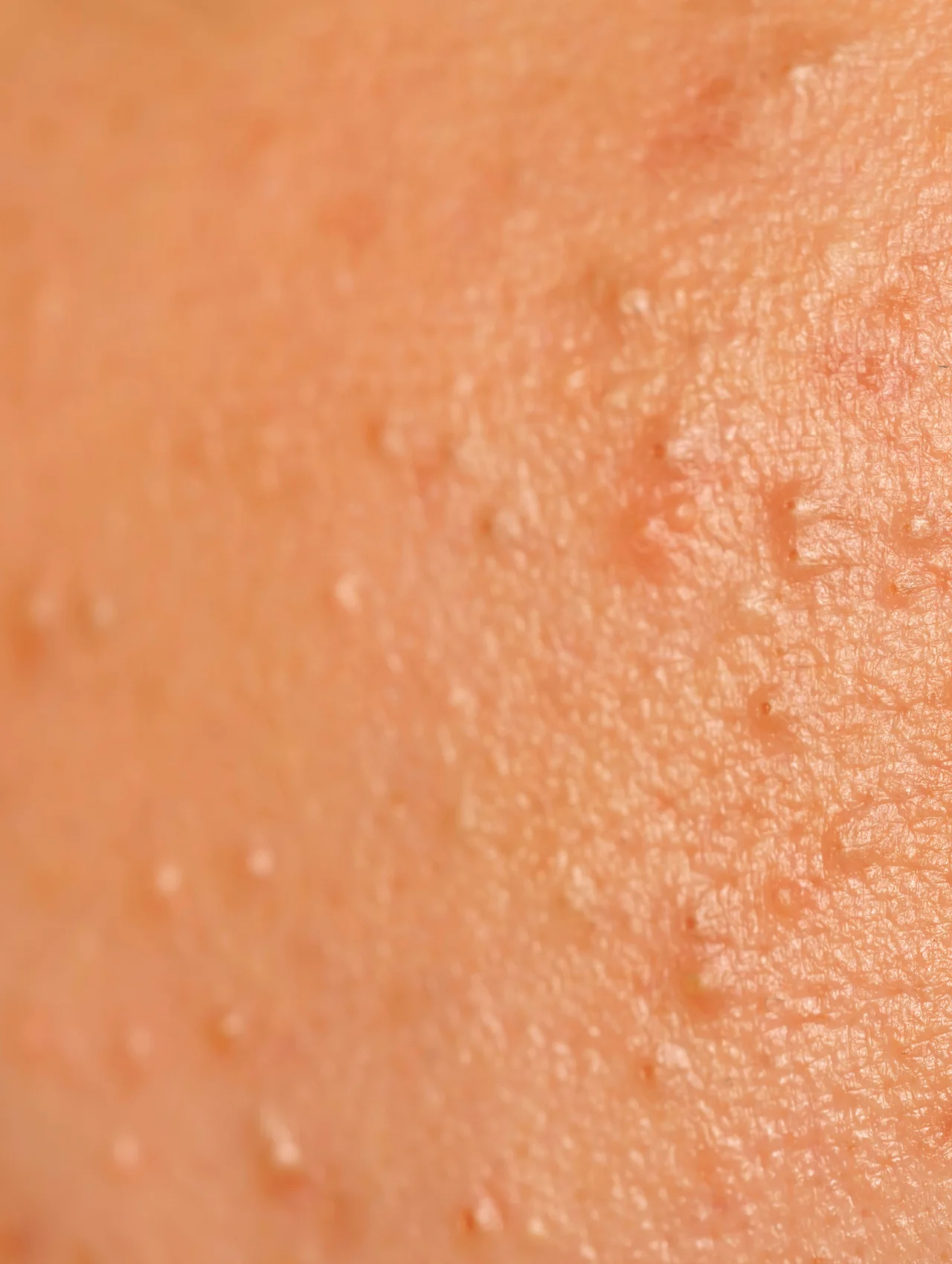 Close-up of small uniform bumps on skin, a key sign that points toward the best treatment for fungal acne